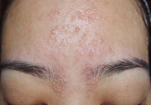 Kết quả chăm sóc da dầu mụn tại Mocora