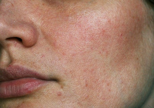 Kết quả chăm sóc đồng đều màu da sau mụn tại Mocora