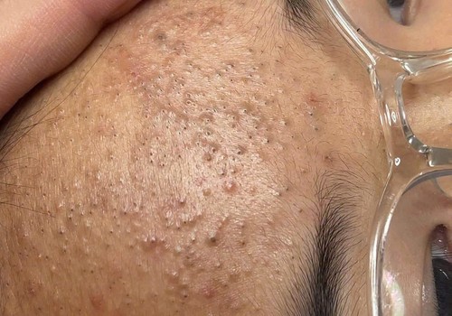 Kết quả chăm sóc phục hồi sau mụn tại Mocora