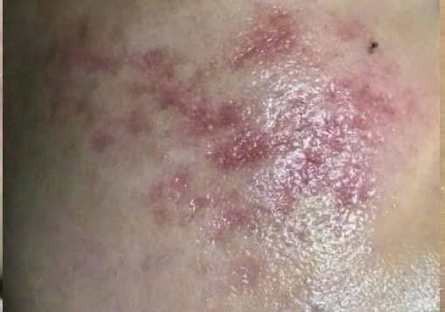 Kết quả Exo căng bóng làm đầy nền da do mụn tại Mocora