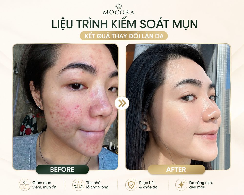 Trước và sau liệu trình kiểm soát mụn tại Mocora