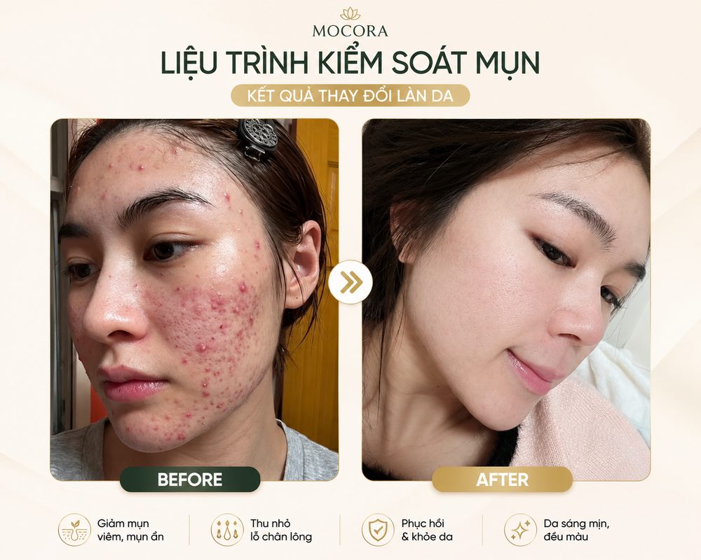 Trước và sau liệu trình kiểm soát mụn tại Mocora