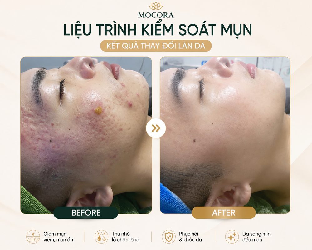 Trước và sau liệu trình kiểm soát mụn tại Mocora