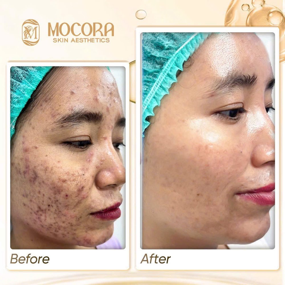 Trước và sau liệu trình kiểm soát mụn tại Mocora