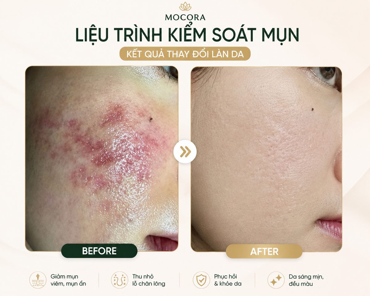 Trước và sau liệu trình kiểm soát mụn tại Mocora — case nổi bật