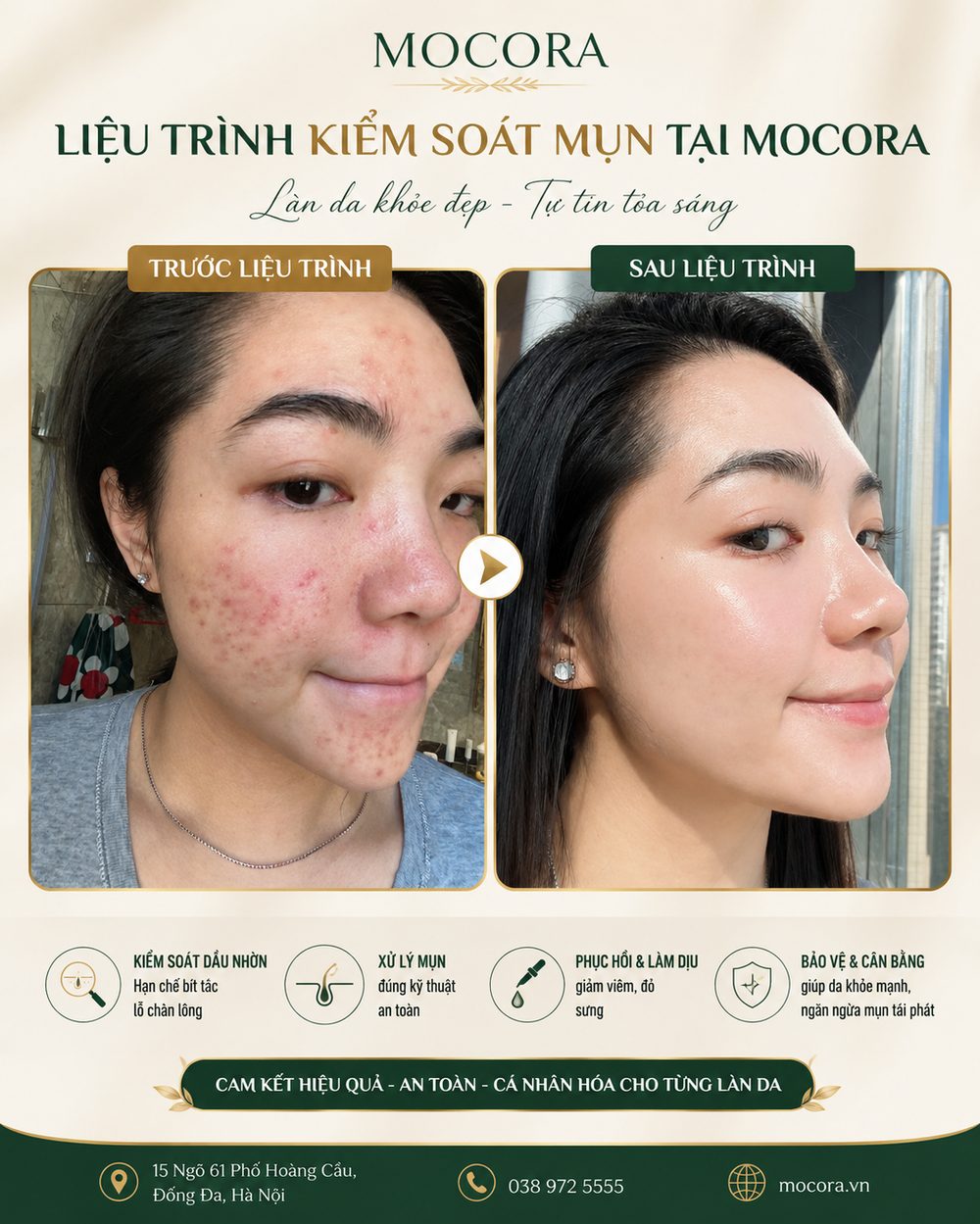 Quy trình chăm sóc da mụn tại Mocora